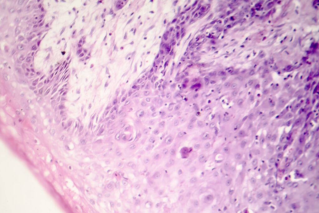 Cutaneous squamous cell carcinoma - Golden State Dermatology