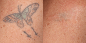 Tatto Removal blog