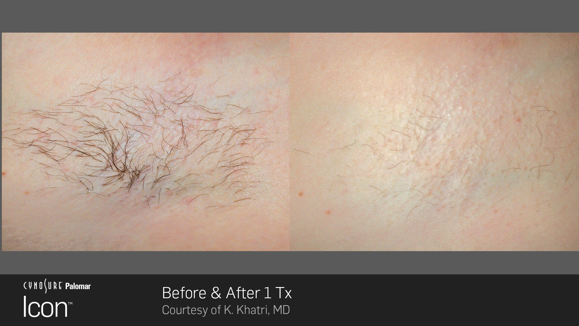 Hair-Removal-Before-&-After-4