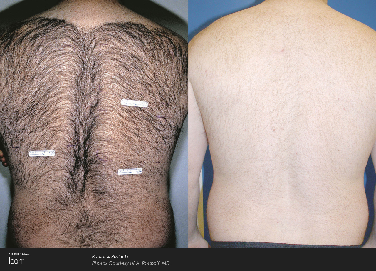 Hair-Removal-Before-&-After-Photo-1