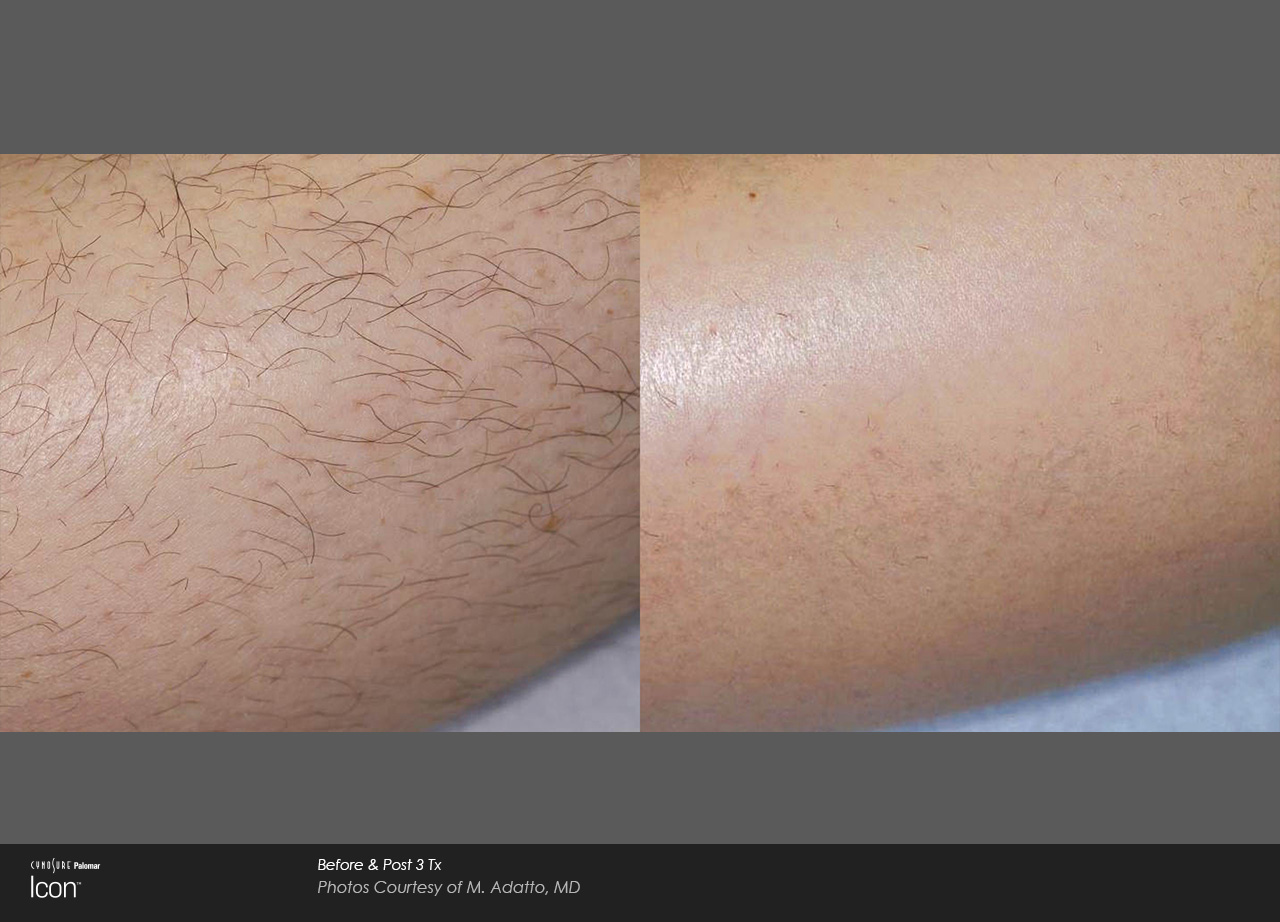 Hair-Removal-Before-&-After-Photo-2