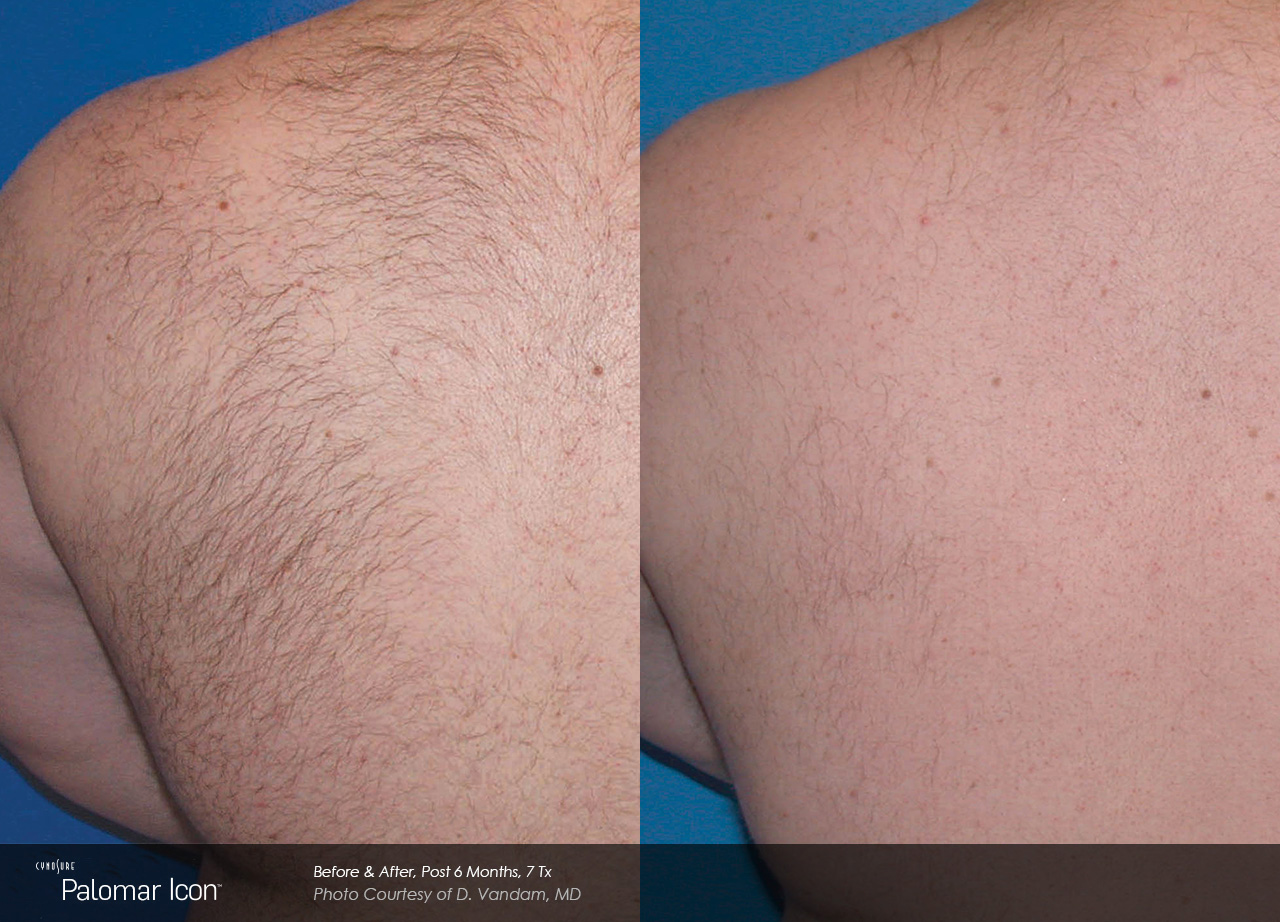 Hair-Removal-Before-&-After-Photo-3