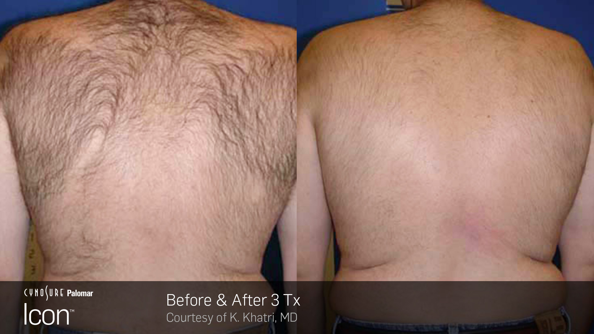 Hair-Removal-Before-&-After-Photo-5