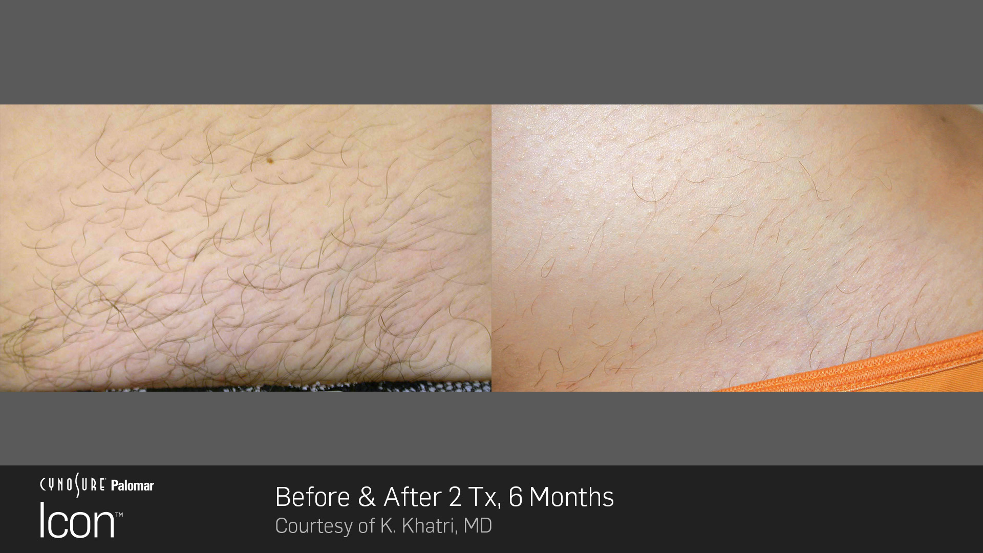 Hair-Removal-Before-&-After-Photo-7