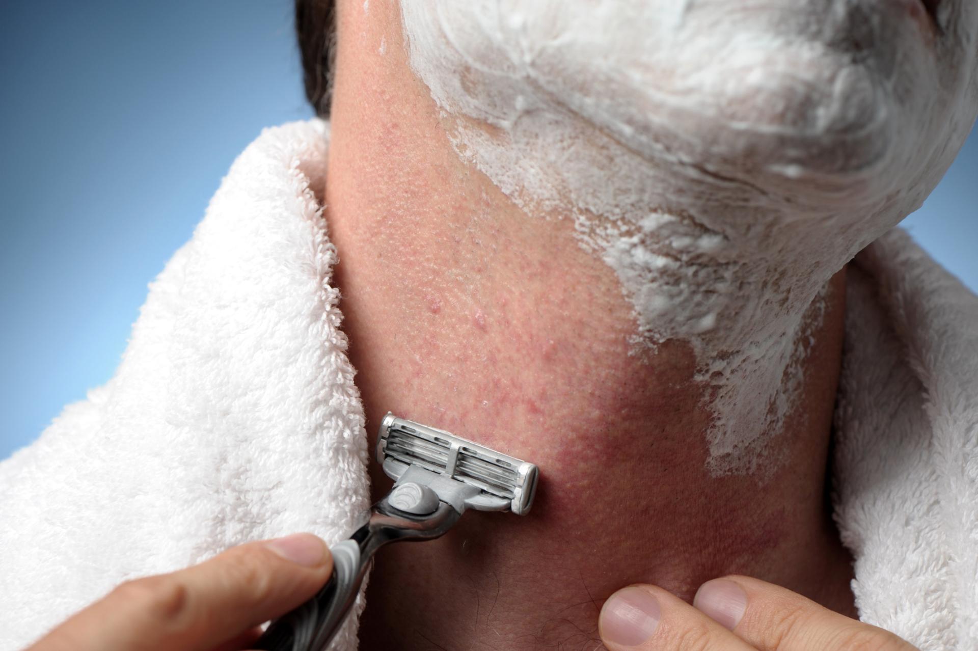 Shave Bumps Do You Need More Than Just Adjusted Grooming Habits 